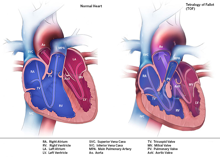 Images of Normal Heart Anatomy and Tetralogy of Fallot Anatomy